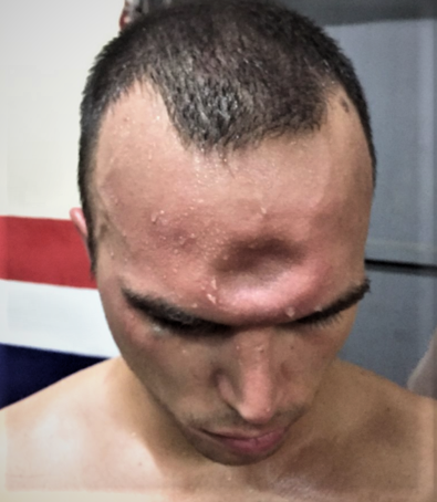 Piston to Forehead (2).png